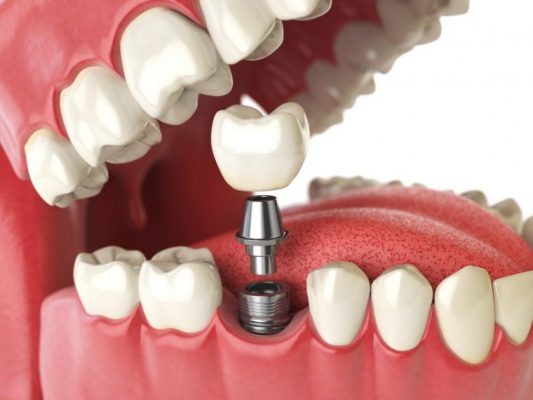 trồng răng implant có đau không