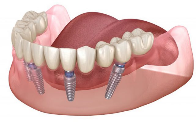 trồng răng implant có đau không