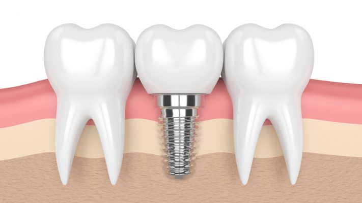 chi phí trồng răng implant