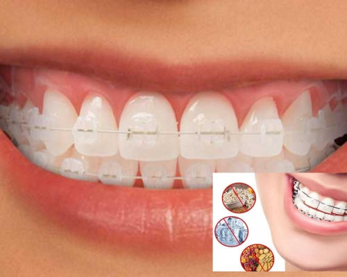 Bí quyết để niềng răng mắc cài sứ để đạt kết quả tốt nhất