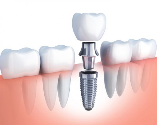 Trồng răng implant giá bao nhiêu 1 cái