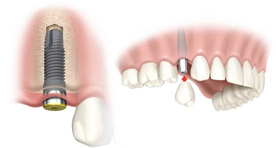 Trồng răng implant giá bao nhiêu 1 cái