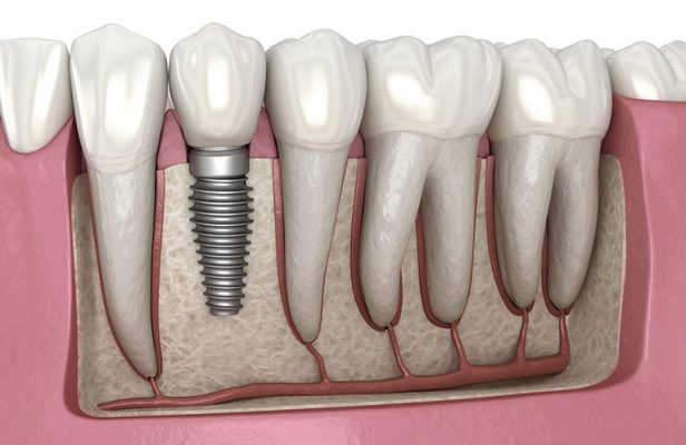 trồng răng implant bao nhiêu tiền