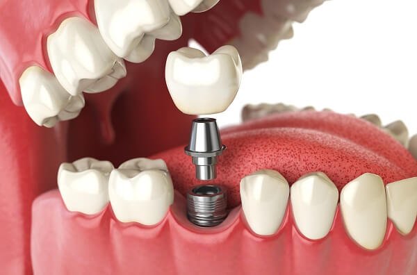 trồng răng implant bao nhiêu tiền