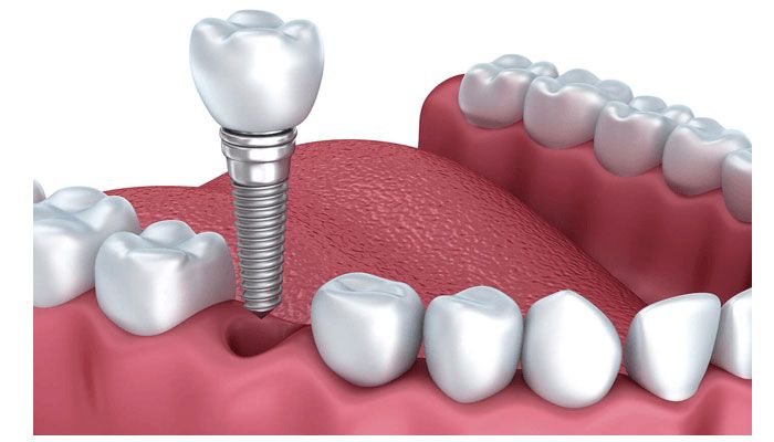 cắm răng implant