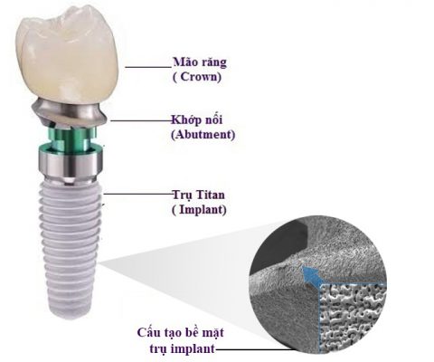 cắm răng implant