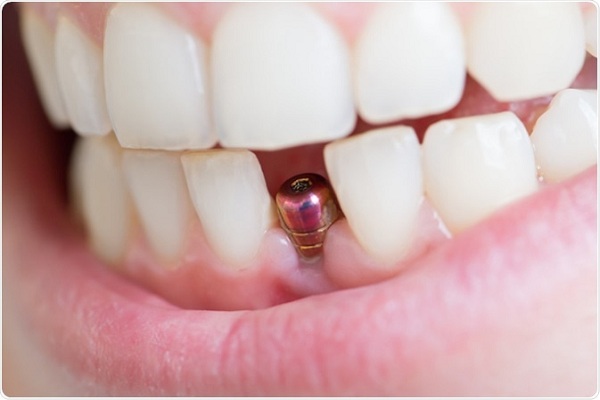 cắm răng implant