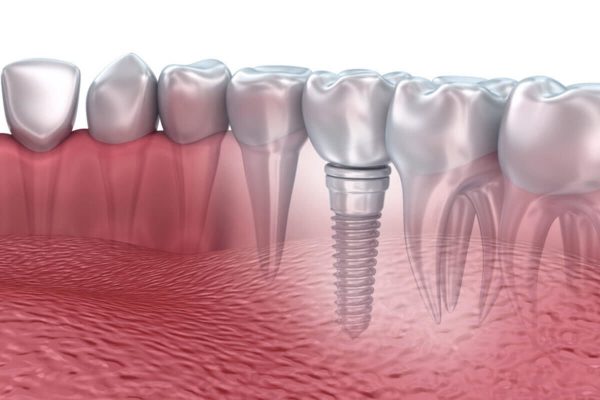 Hình ảnh trồng răng implant - Đánh giá hiệu quả phương pháp