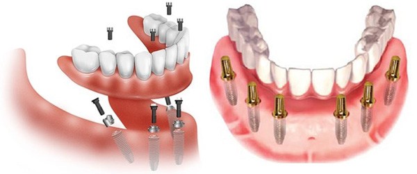 Hình ảnh trồng răng implant - Đánh giá hiệu quả phương pháp