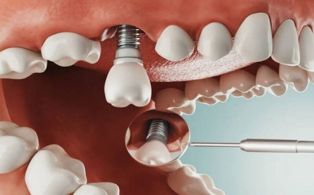 trồng răng sứ implant