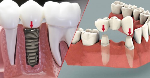 trồng răng sứ implant