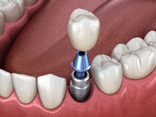 trồng răng sứ implant