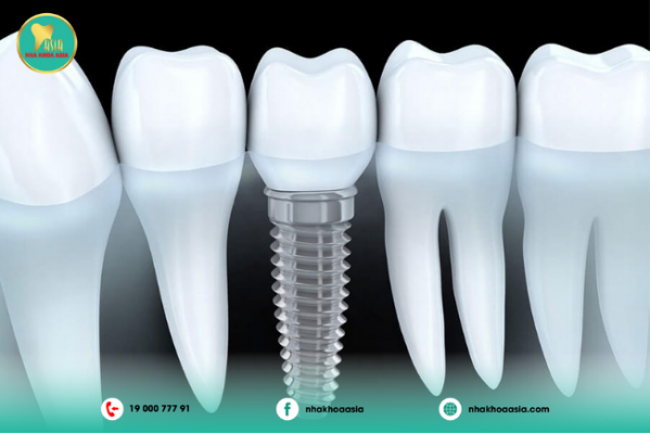 TOP 11 địa chỉ trồng răng implant uy tín TPHCM giá rẻ chất lượng