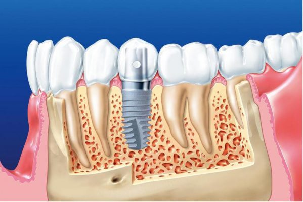 trồng răng implant bao lâu thì lành