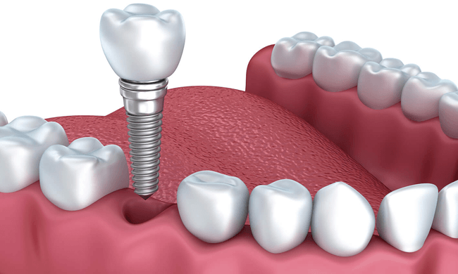 61 trong rang implant bao lau thi lanh 3