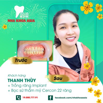 Lưu ý chăm sóc răng miệng sau khi trồng răng implant