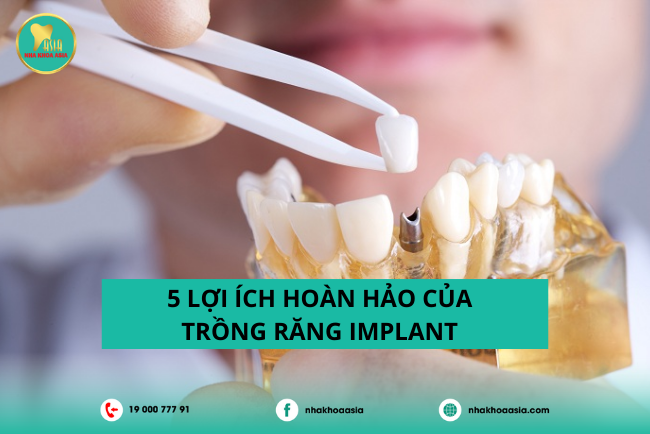 Trồng răng Implant mang lại những lợi ích gì?