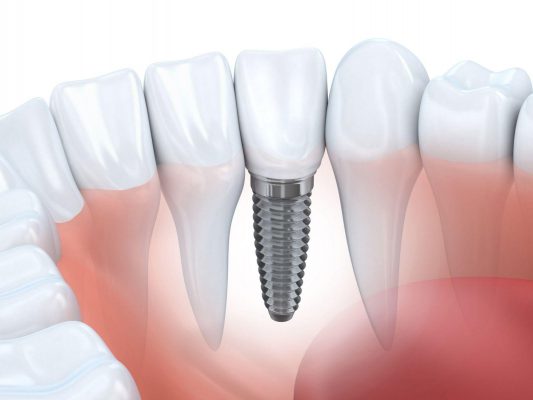 Trồng răng sứ implant giá bao nhiêu