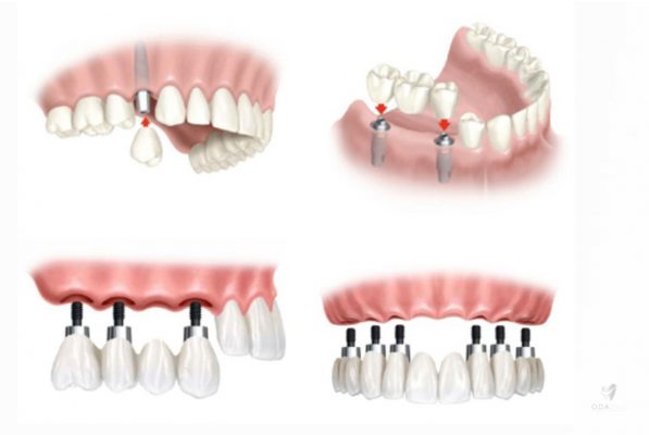 lam rang implant gia 3