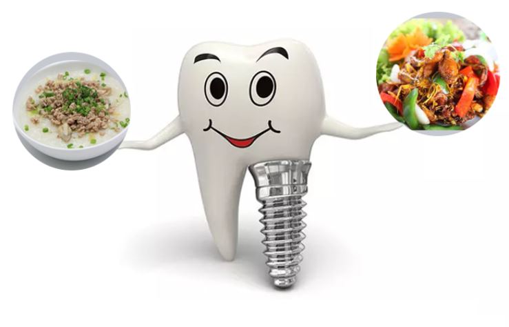 Sau khi Trồng răng Implant bao lâu ăn được bình thường?