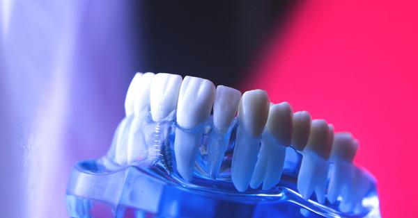 Trồng răng sứ implant giá bao nhiêu