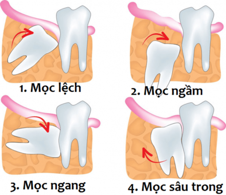 nhổ răng khôn bao nhiêu tiền