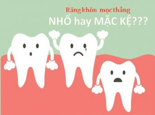 Có nên nhổ răng khôn hay không? Răng khôn mọc thẳng nhổ hya không?