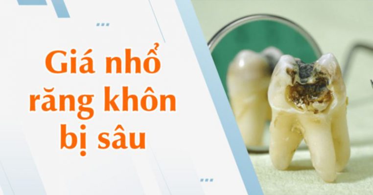 nhổ răng khôn giá bao nhiêu