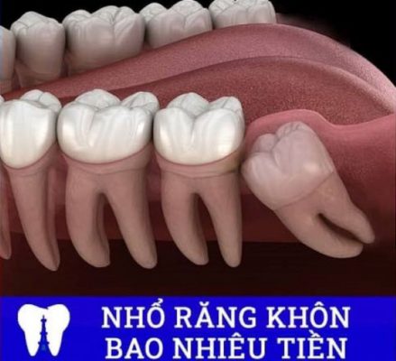 nhổ răng khôn giá bao nhiêu