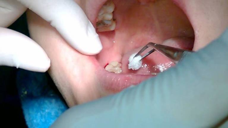 Trường hợp nào cần tiến hành nhổ bỏ răng khôn hàm trên?