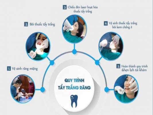 tẩy trắng răng uy tín