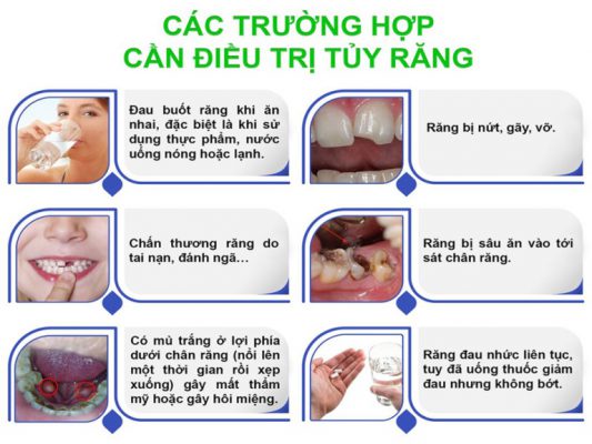 chữa viêm tủy răng uy tín