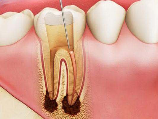 chữa viêm tủy răng uy tín