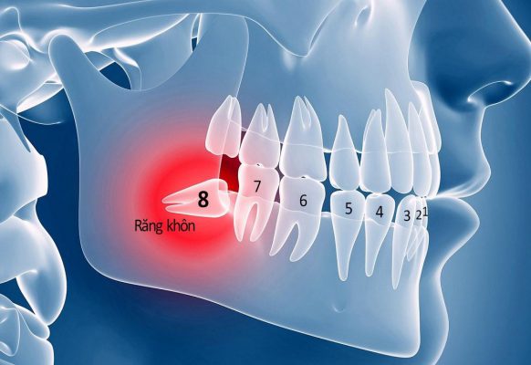 nhổ răng khôn đau không