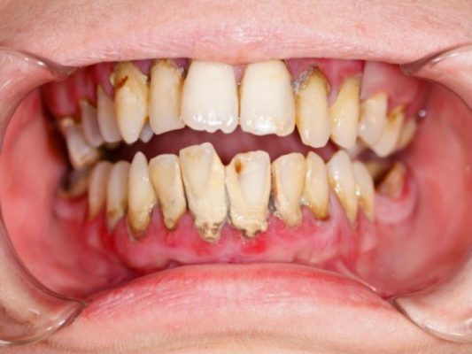 Không lấy cao răng có sao không?