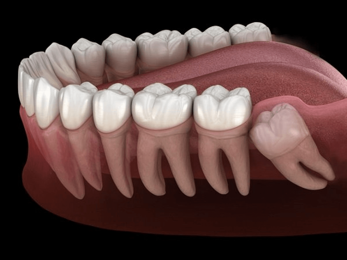 Răng khôn là gì? Răng khôn thường mọc ở đâu?