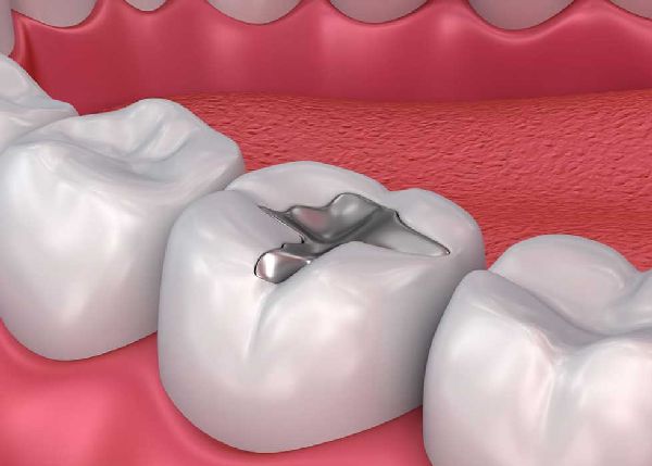 Có nên trám răng sâu nặng ngay khi phát hiện bệnh?
