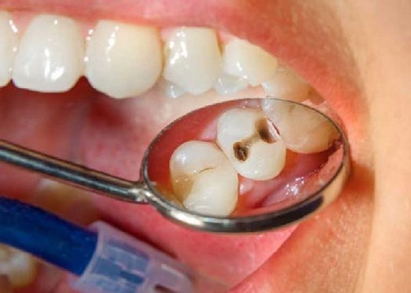Quá trình trám răng sâu lỗ nhỏ mất bao lâu?
