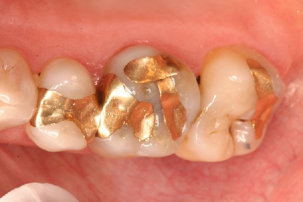 Tìm hiểu trám răng mất bao nhiêu tiền - Chi phí nha khoa