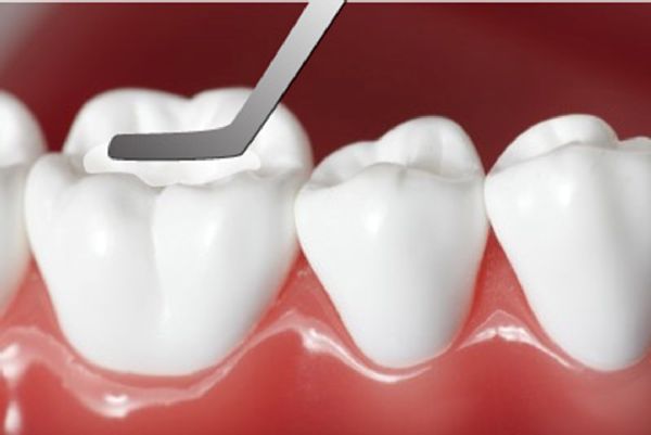 Răng sứ có phải là một phương pháp thẩm mỹ để cải thiện nụ cười không? 
