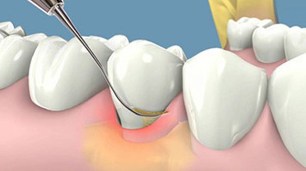 tác hại của cao răng 