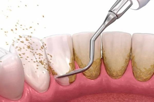 Tác dụng của lấy cao răng 3