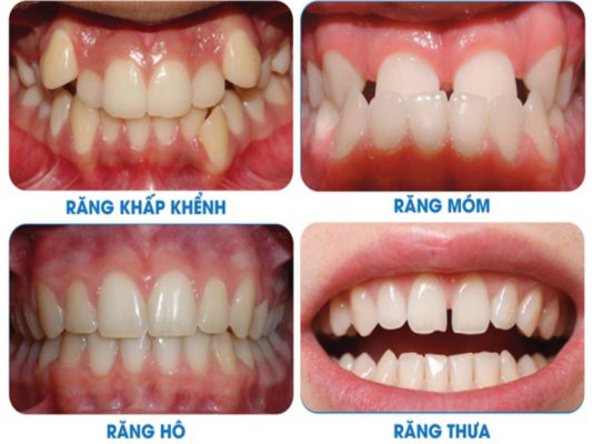 bảng báo giá niềng răng trong suốt giá rẻ