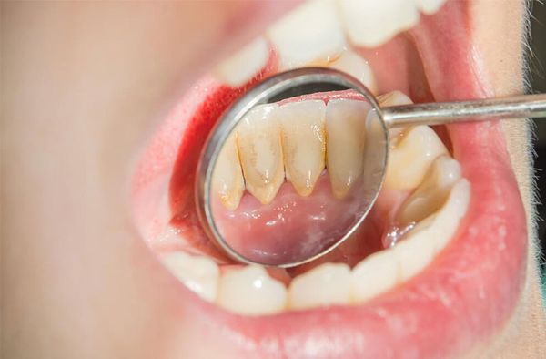 Làm sao để biết có cao răng tích tụ hay không?
