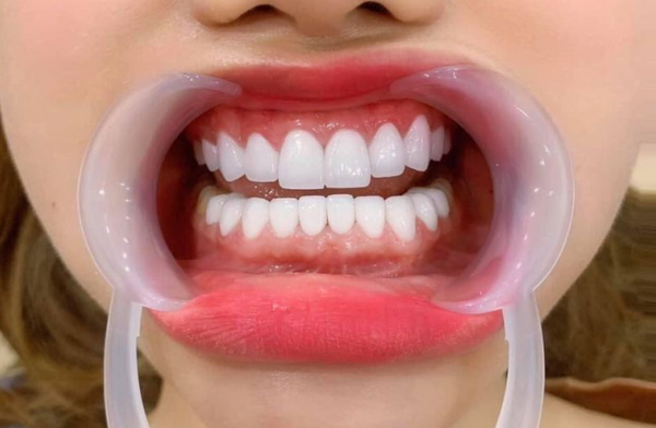 Bọc sứ răng cửa trường hợp nào không nên thực hiện?