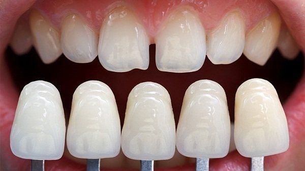 Bọc sứ răng cửa trường hợp nào nên thực hiện?