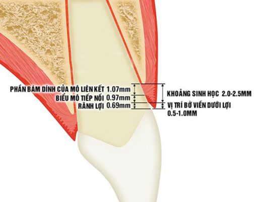 bọc răng sứ bị viêm lợi 2