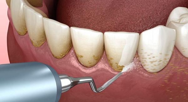 Có nên cạo vôi răng nhiều hay không?
