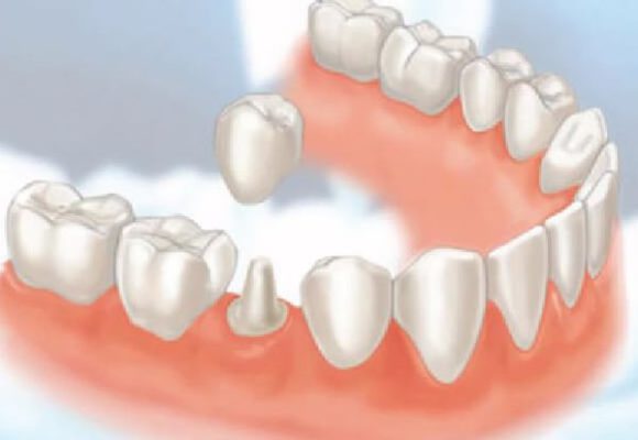 Bọc răng sứ có ăn uống bình thường được không 4