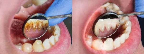 Tại sao vôi răng có thể bị vỡ?
